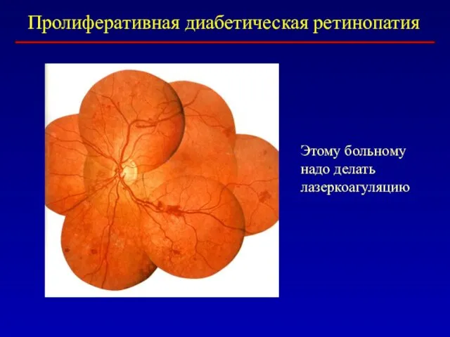 Пролиферативная диабетическая ретинопатия Этому больному надо делать лазеркоагуляцию