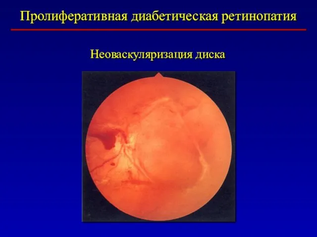 Пролиферативная диабетическая ретинопатия Неоваскуляризация диска