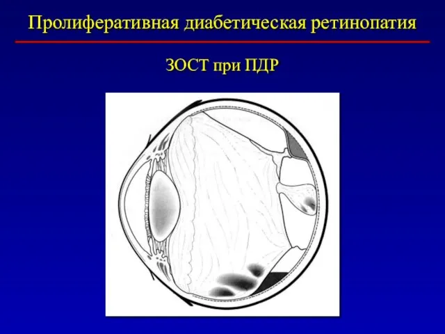 Пролиферативная диабетическая ретинопатия ЗОСТ при ПДР