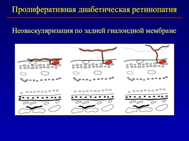 Пролиферативная диабетическая ретинопатия Неоваскуляризация по задней гиалоидной мембране