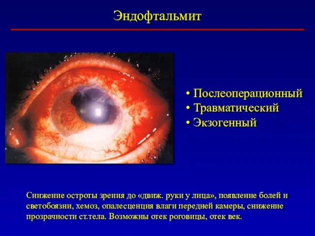 Эндофтальмит Снижение остроты зрения до «движ. руки у лица», появление болей