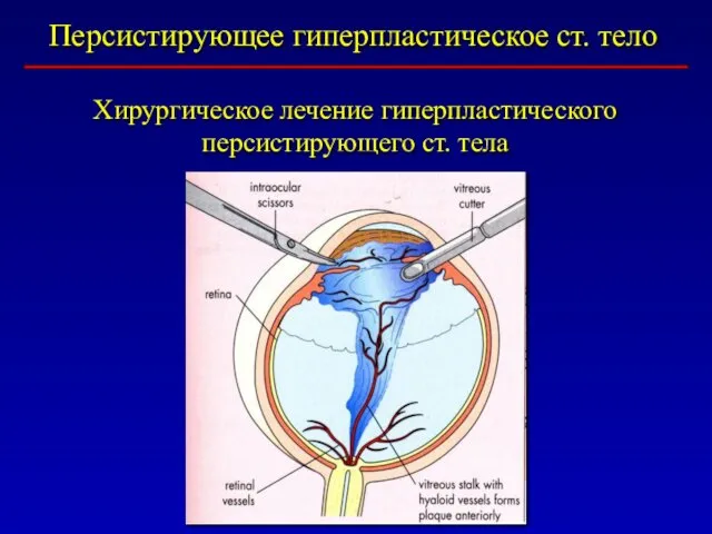 Персистирующее гиперпластическое ст. тело Хирургическое лечение гиперпластического персистирующего ст. тела