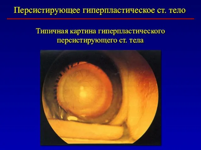 Персистирующее гиперпластическое ст. тело Типичная картина гиперпластического персистирующего ст. тела