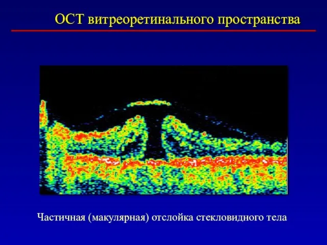 ОСТ витреоретинального пространства Частичная (макулярная) отслойка стекловидного тела