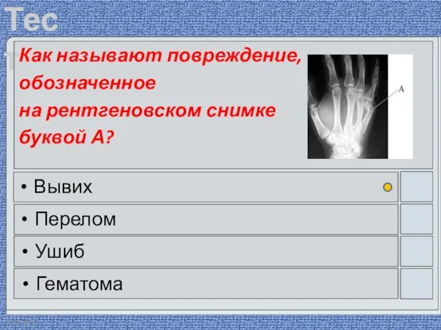 22.03.2016 Как называют повреждение, обозначенное на рентгеновском снимке буквой А? Вывих Перелом Ушиб Гематома