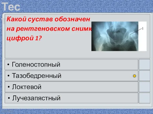 22.03.2016 Какой сустав обозначен на рентгеновском снимке цифрой 1? Голеностопный Тазобедренный Локтевой Лучезапястный