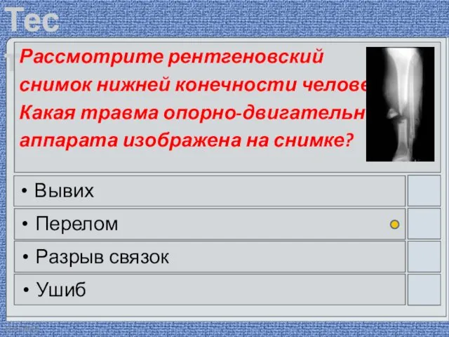 22.03.2016 Рассмотрите рентгеновский снимок нижней конечности человека. Какая травма опорно-двигательного аппарата