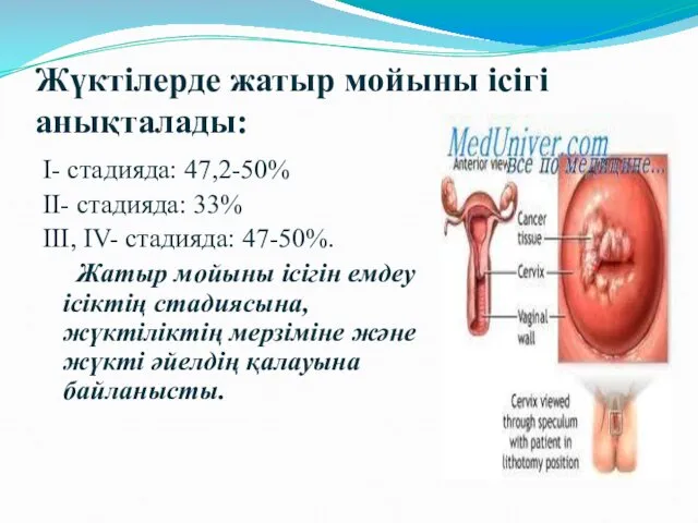 Жүктілерде жатыр мойыны ісігі анықталады: I- стадияда: 47,2-50% II- стадияда: 33%