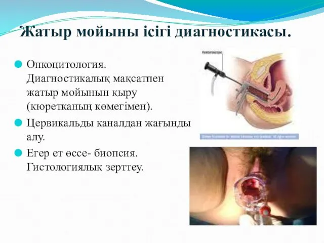 Жатыр мойыны ісігі диагностикасы. Онкоцитология. Диагностикалық мақсатпен жатыр мойынын қыру (кюретканың