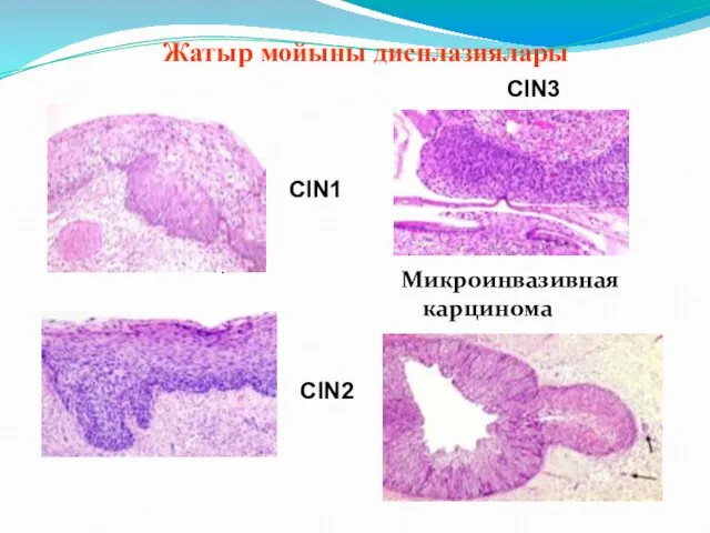 Микроинвазивная карцинома CIN1 CIN2 CIN3 . Жатыр мойыны дисплазиялары