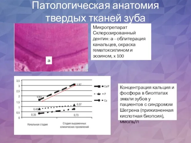 Патологическая анатомия твердых тканей зуба Микропрепарат Склерозированный дентин: а - облитерация