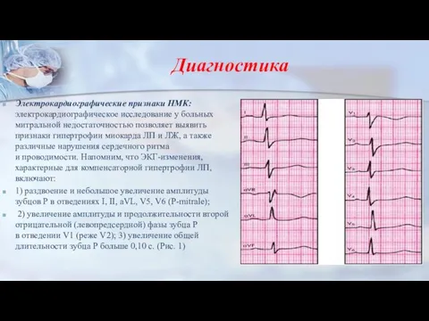 Диагностика Электрокардиографические признаки НМК: электрокардиографическое исследование у больных митральной недостаточностью позволяет