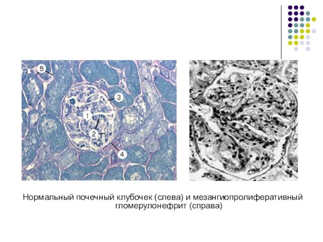 Нормальный почечный клубочек (слева) и мезангиопролиферативный гломерулонефрит (справа)