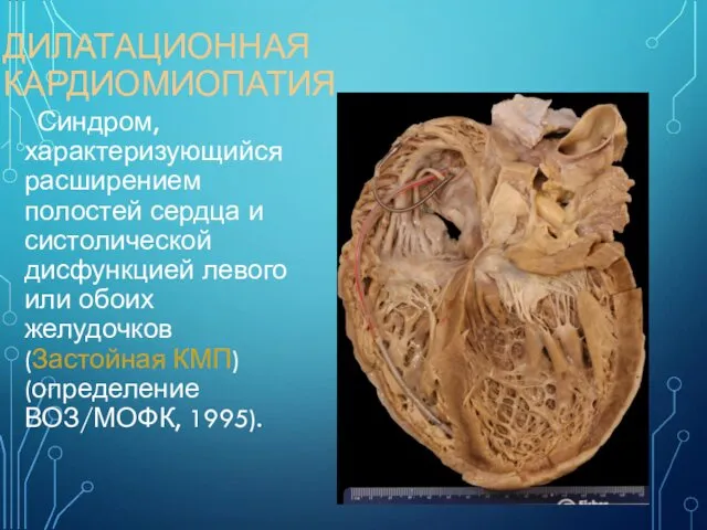 ДИЛАТАЦИОННАЯ КАРДИОМИОПАТИЯ Синдром, характеризующийся расширением полостей сердца и систолической дисфункцией левого