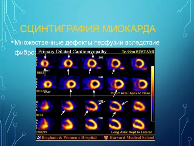 СЦИНТИГРАФИЯ МИОКАРДА Множественные дефекты перфузии вследствие фиброза.