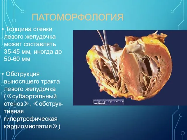 ПАТОМОРФОЛОГИЯ Толщина стенки левого желудочка может составлять 35-45 мм, иногда до