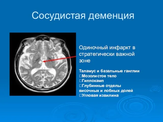 Сосудистая деменция Одиночный инфаркт в стратегически важной зоне Таламус и базальные