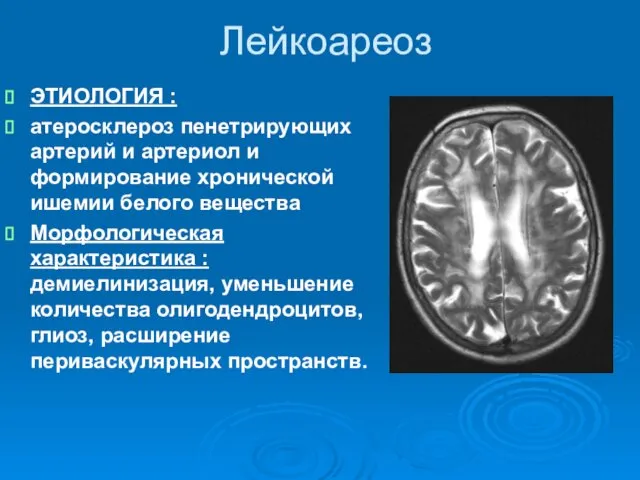 Лейкоареоз ЭТИОЛОГИЯ : атеросклероз пенетрирующих артерий и артериол и формирование хронической