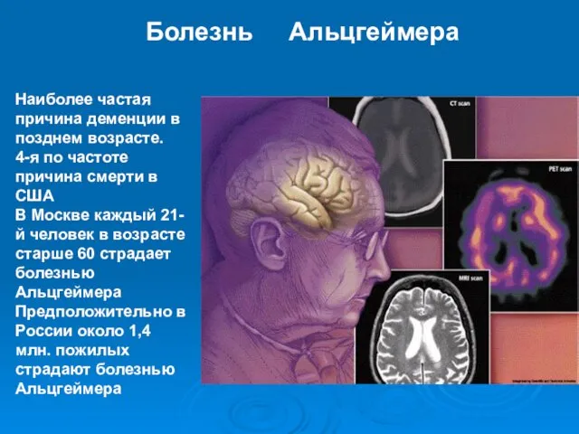 Болезнь Альцгеймера Наиболее частая причина деменции в позднем возрасте. 4-я по