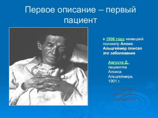 Первое описание – первый пациент 51-летняя женщина с деменцией в 1906