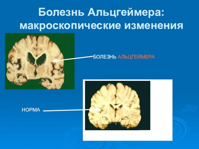 Болезнь Альцгеймера: макроскопические изменения БОЛЕЗНЬ АЛЬЦГЕЙМЕРА НОРМА