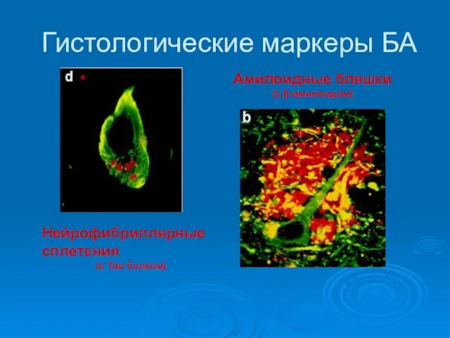 Гистологические маркеры БА Нейрофибриллярные сплетения (с Tau белком) Амилоидные бляшки (с β-амилоидом)