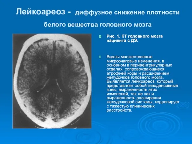 Лейкоареоз - диффузное снижение плотности белого вещества головного мозга Рис. 1.