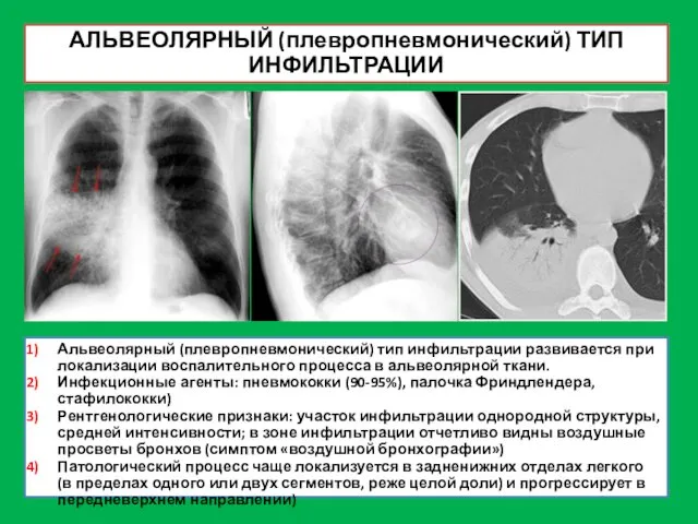 АЛЬВЕОЛЯРНЫЙ (плевропневмонический) ТИП ИНФИЛЬТРАЦИИ Альвеолярный (плевропневмонический) тип инфильтрации развивается при локализации