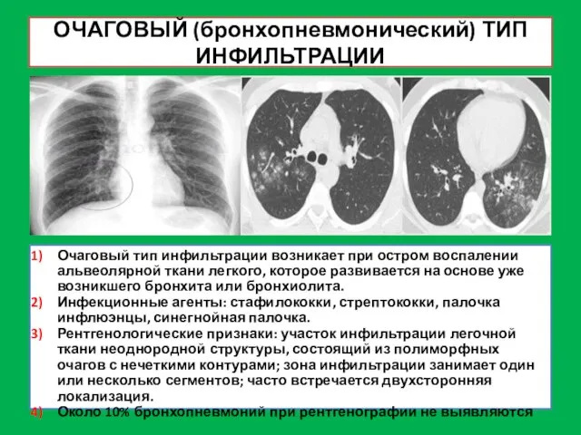 ОЧАГОВЫЙ (бронхопневмонический) ТИП ИНФИЛЬТРАЦИИ Очаговый тип инфильтрации возникает при остром воспалении