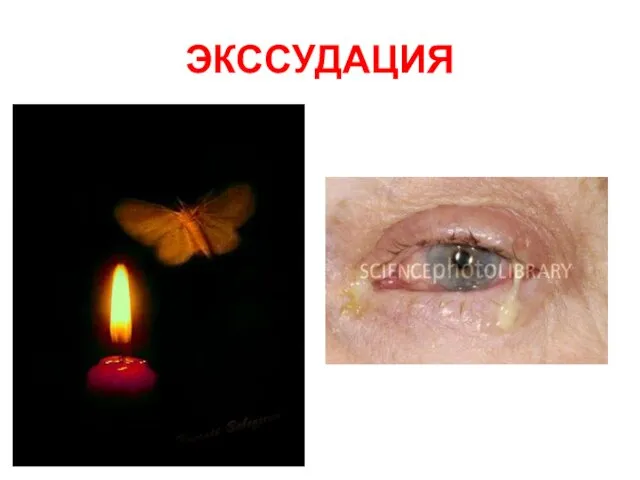 ЭКССУДАЦИЯ