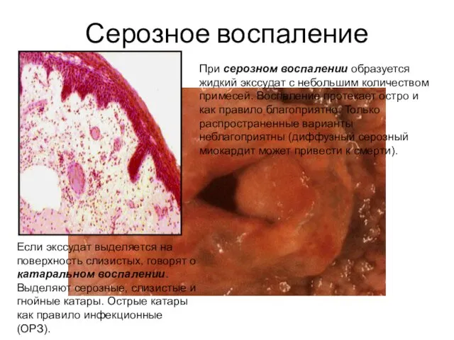 Серозное воспаление При серозном воспалении образуется жидкий экссудат с небольшим количеством