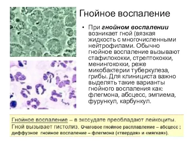 Гнойное воспаление При гнойном воспалении возникает гной (вязкая жидкость с многочисленными