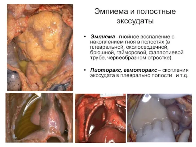 Эмпиема и полостные экссудаты Эмпиема - гнойное воспаление с накоплением гноя