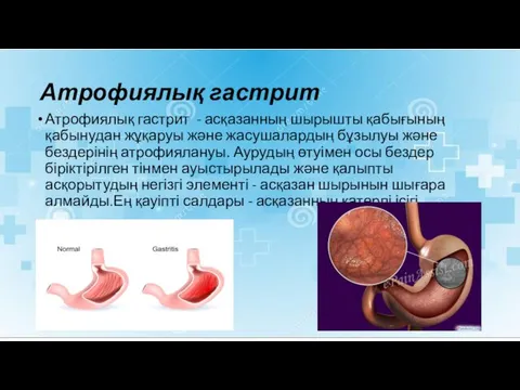 Атрофиялық гастрит Атрофиялық гастрит - асқазанның шырышты қабығының қабынудан жұқаруы және