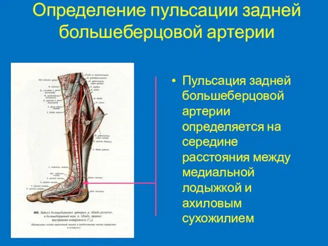 Определение пульсации задней большеберцовой артерии Пульсация задней большеберцовой артерии определяется на