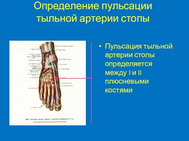 Определение пульсации тыльной артерии стопы Пульсация тыльной артерии стопы определяется между I и II плюсневыми костями