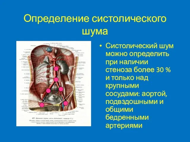 Определение систолического шума Систолический шум можно определить при наличии стеноза более