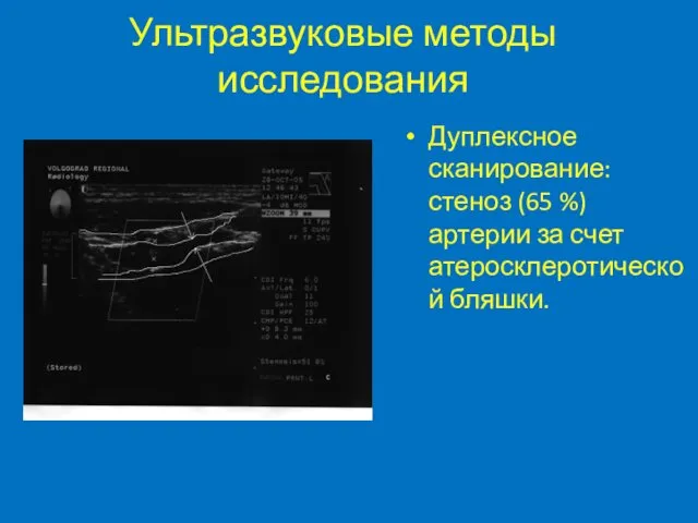 Ультразвуковые методы исследования Дуплексное сканирование: стеноз (65 %) артерии за счет атеросклеротической бляшки.