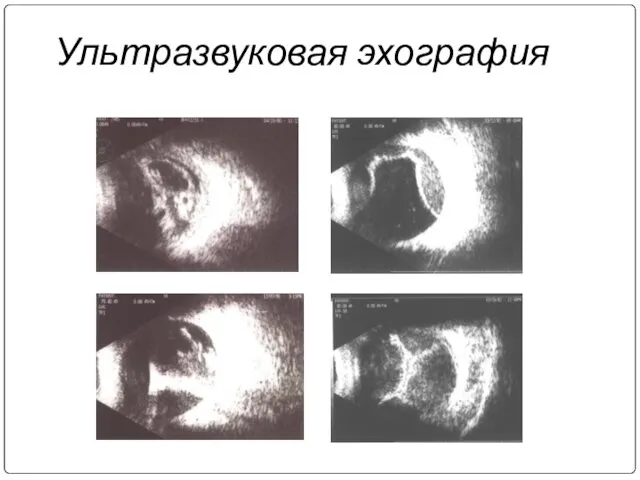 Ультразвуковая эхография