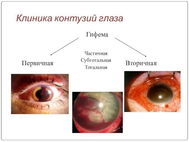 Клиника контузий глаза Гифема Первичная Вторичная Частичная Субтотальная Тотальная