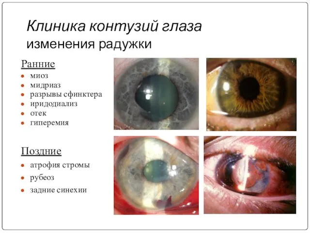 Клиника контузий глаза изменения радужки Ранние миоз мидриаз разрывы сфинктера иридодиализ