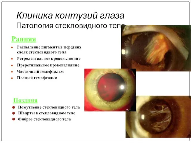 Клиника контузий глаза Патология стекловидного тела Ранняя Распыление пигмента в передних