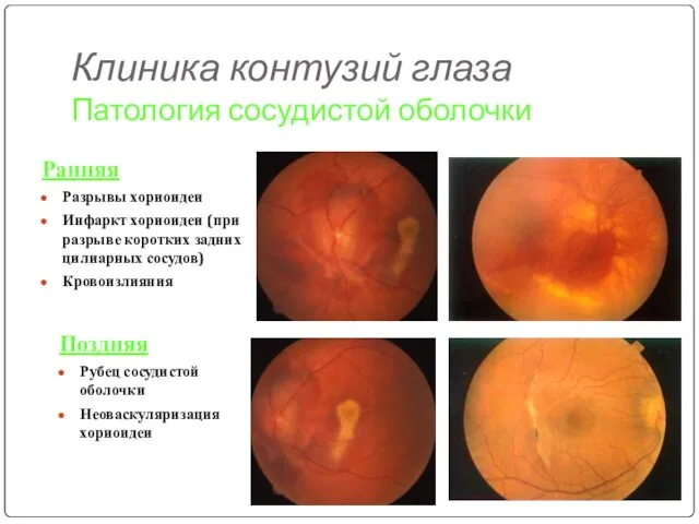 Клиника контузий глаза Патология сосудистой оболочки Ранняя Разрывы хориоидеи Инфаркт хориоидеи