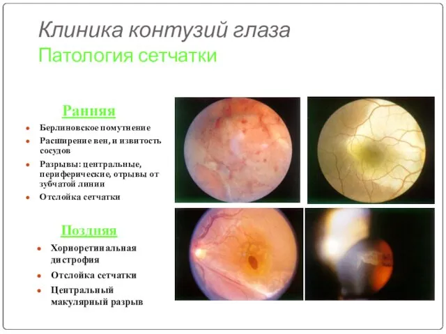 Клиника контузий глаза Патология сетчатки Ранняя Берлиновское помутнение Расширение вен, и