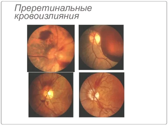 Преретинальные кровоизлияния