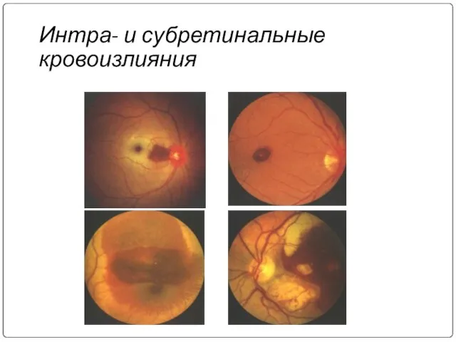 Интра- и субретинальные кровоизлияния