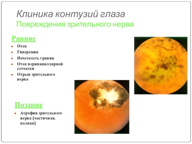 Клиника контузий глаза Повреждения зрительного нерва Ранние Отек Гиперемия Нечеткость границ