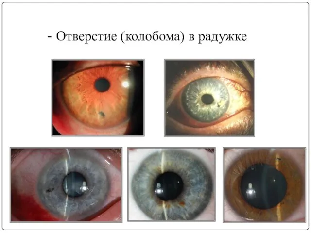 - Отверстие (колобома) в радужке