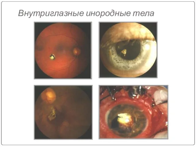 Внутриглазные инородные тела