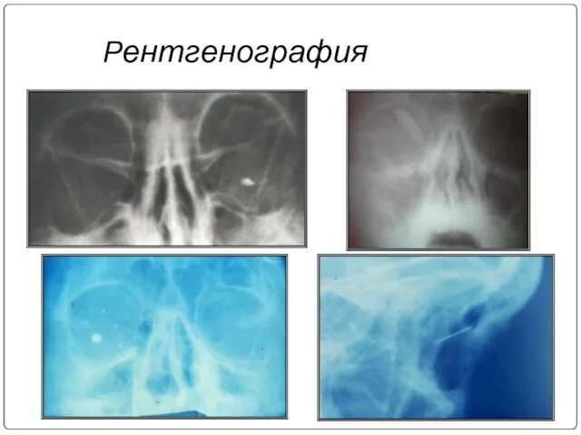 Рентгенография